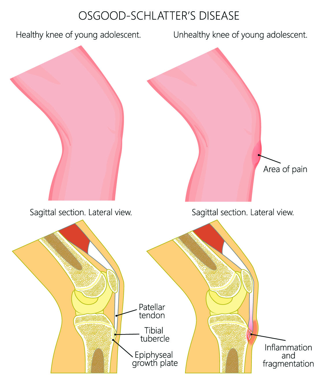 Osgood-Schlatter disease